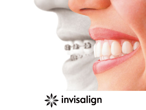 インビザライン